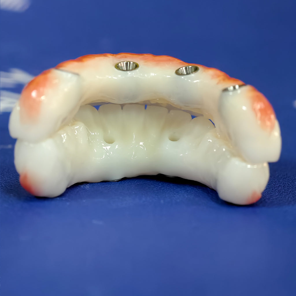 All On 4 Zirconia Bridge With Ti-Base Screw Retained Trying For Full Arch Restoration