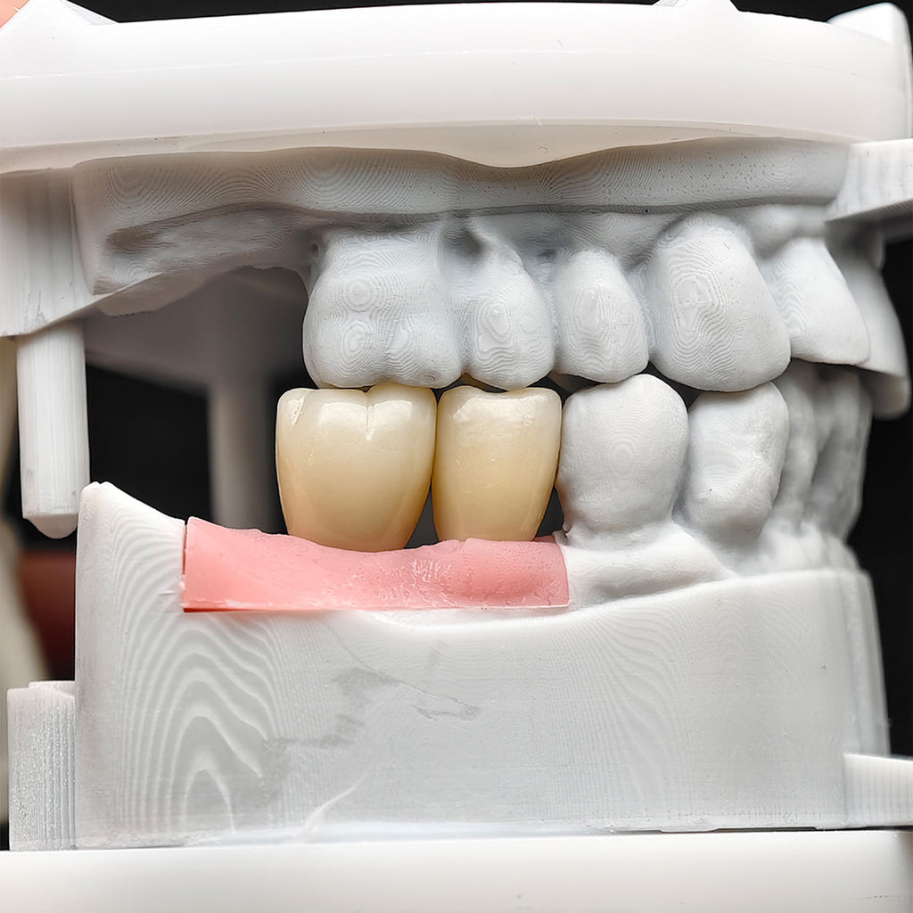 Custom Zirconia Implant Crowns