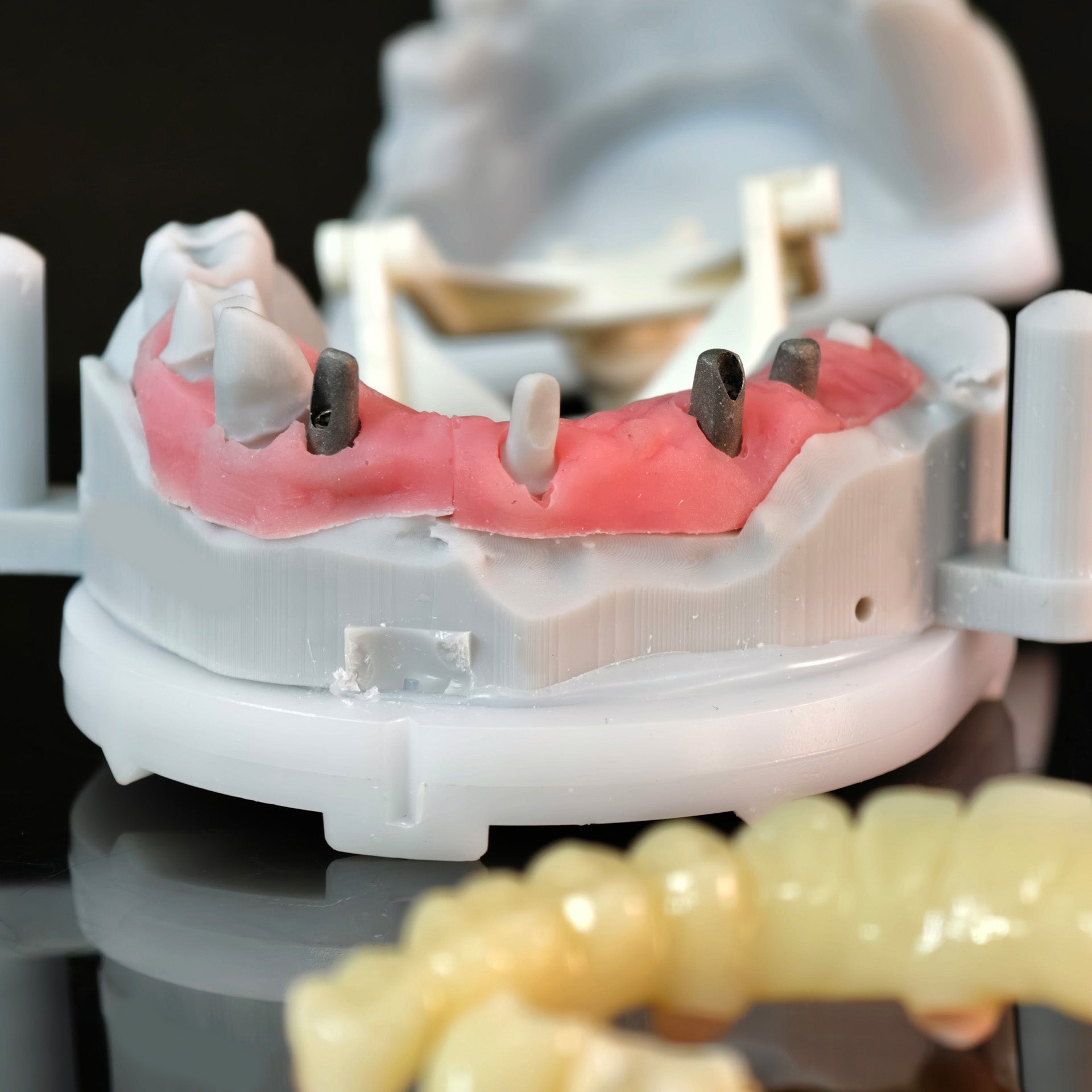 Custom Abutment And PMMA Bridge And Crown With Cement Retained