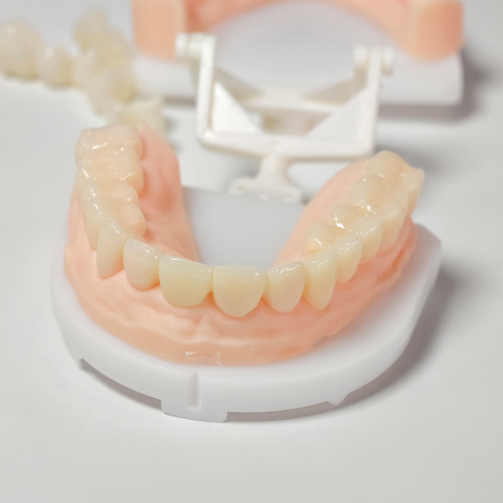 Full-Mouth Segmented PMMA Bridge With Cement Retained