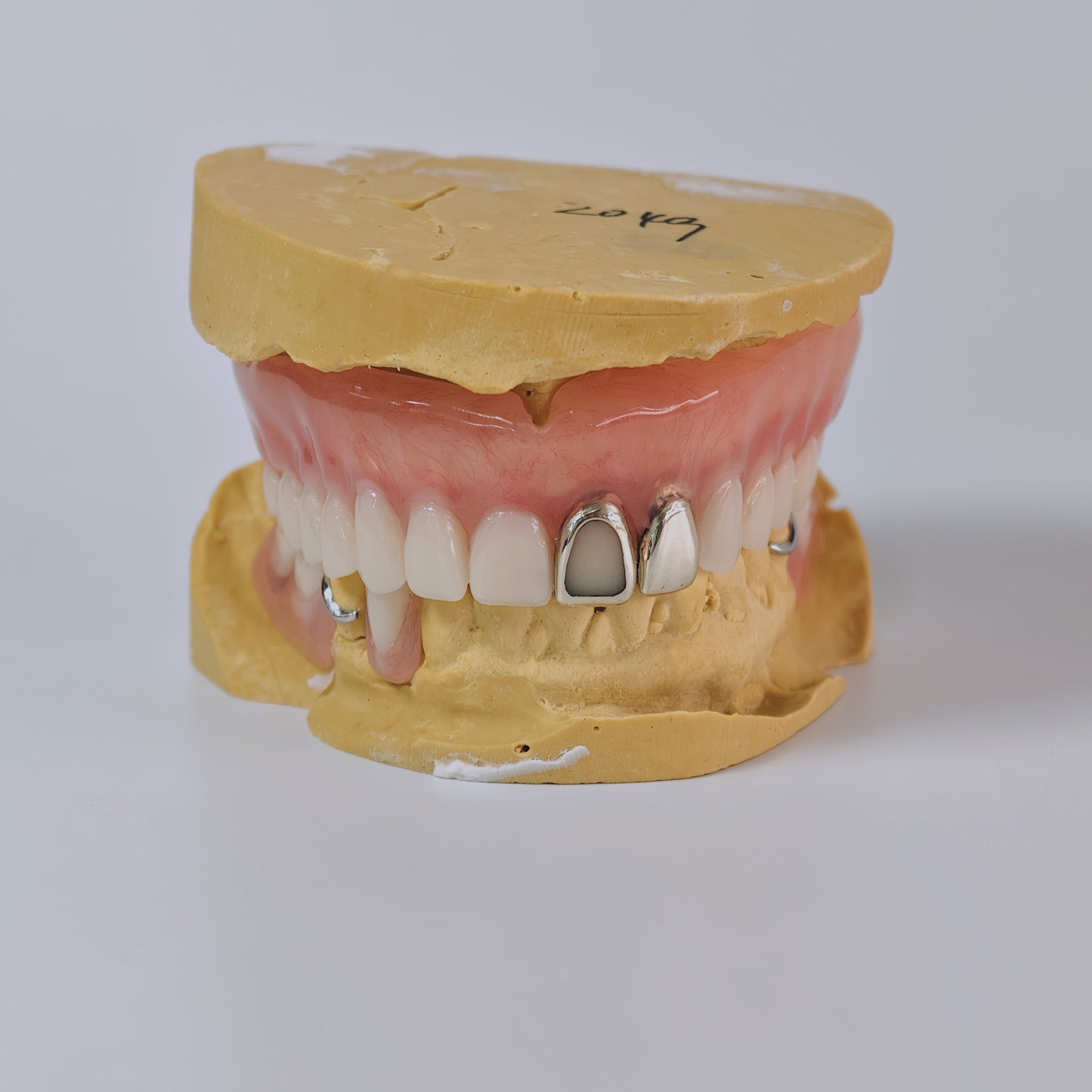 Full-Mouth Acrylic Denture