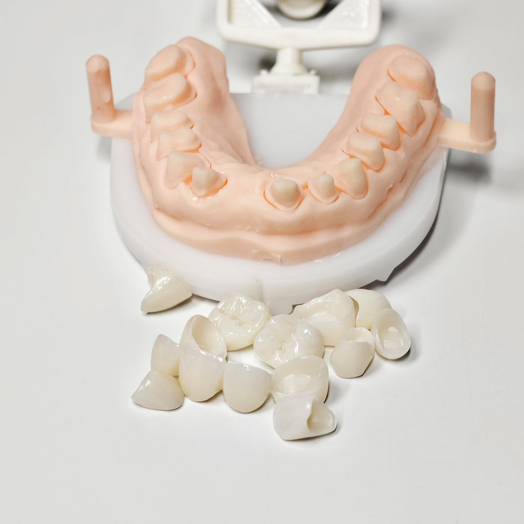 Full-Zriconia Crowns With Cement-Retained