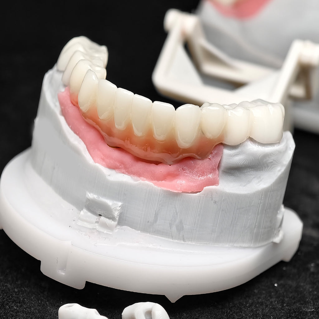 Pmma Bridge With Implant Seating Guide And Cemented