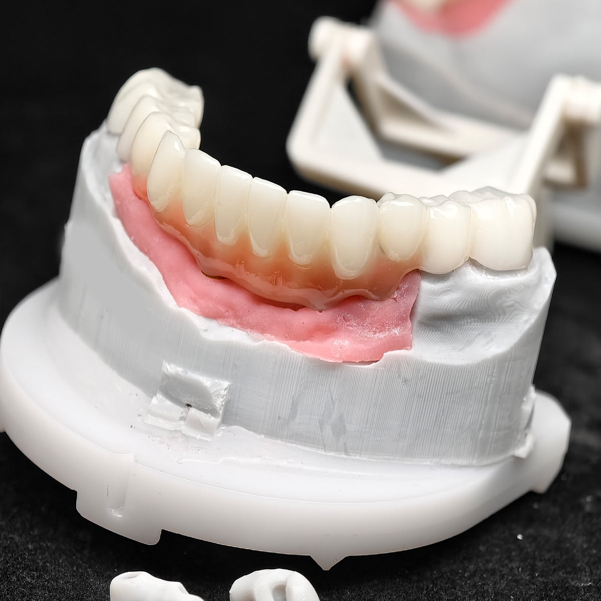 Pmma Bridge With Implant Seating Guide And Cemented