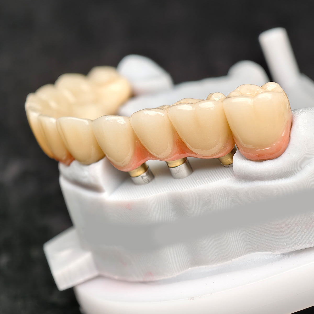 Zirconia Crown And Birdge With Cemented And Implant Seating Guide