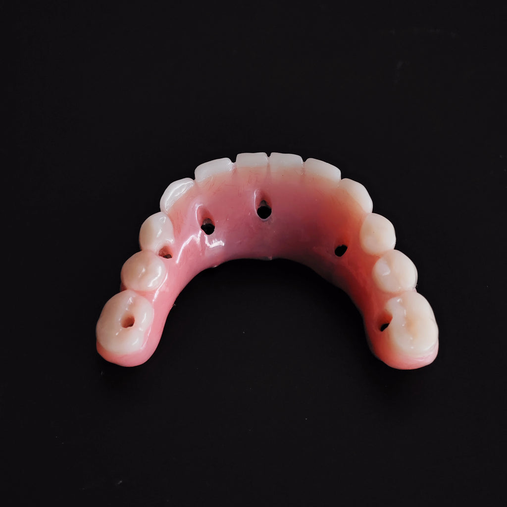 An Acrylic Denture With A Titanium Bar (Ti-Bar) Cost-Effective Full Arch Restoration Screw Retained