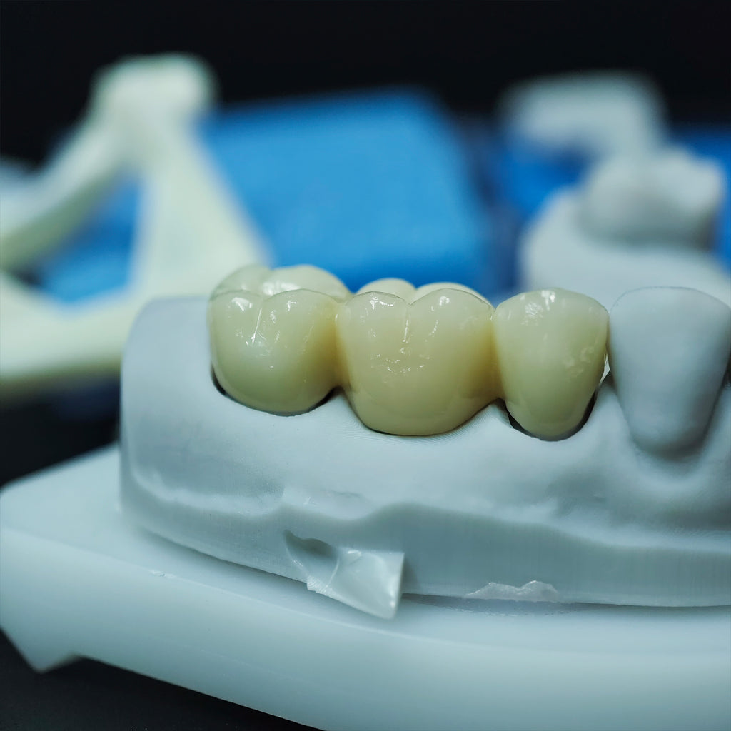 Beautiful Zirconia Bridge