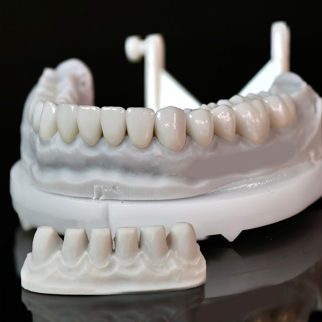 Ceramic Veneers And Crown With Cement Retained