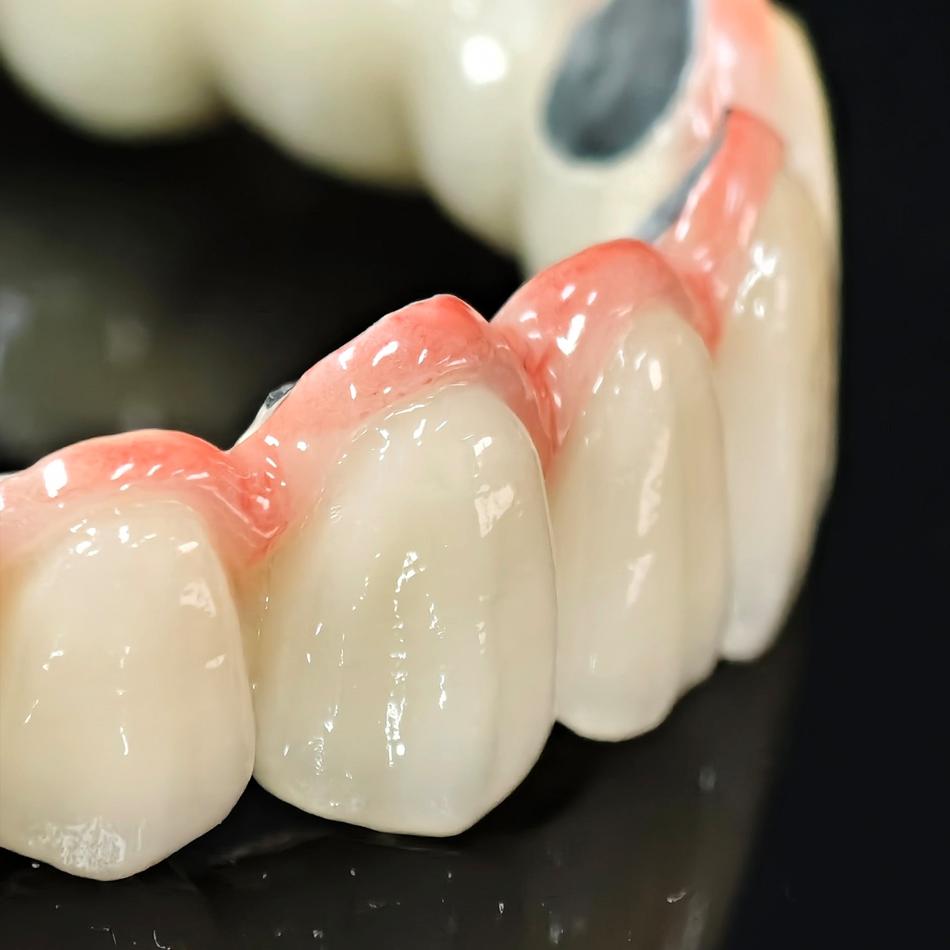 Co - Cr PFM Dental Bridge