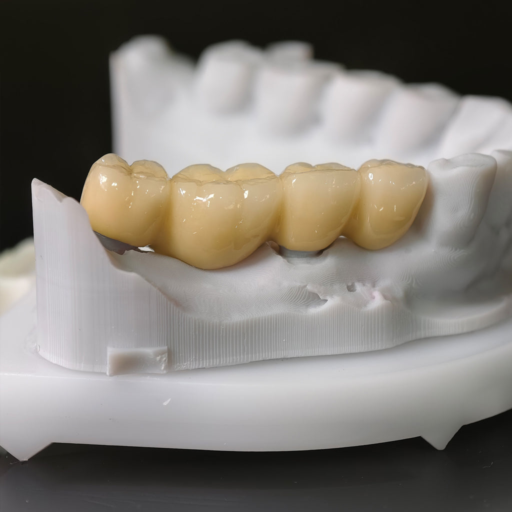 Co - Cr PFM Dental Bridge