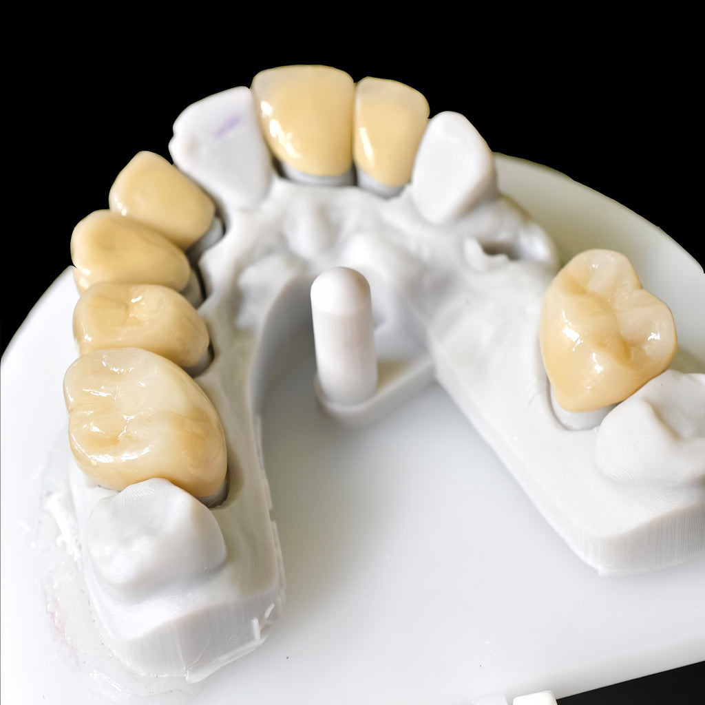 Co - Cr PFM Dental Bridge With Metal Post-And-Core