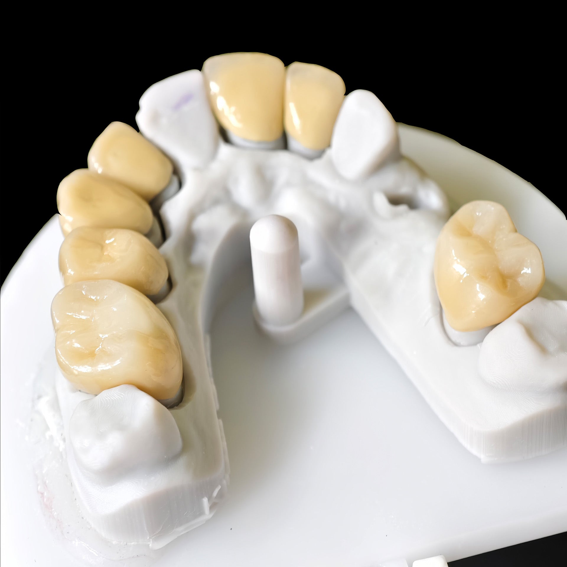 Co - Cr PFM Dental Bridge With Metal Post-And-Core