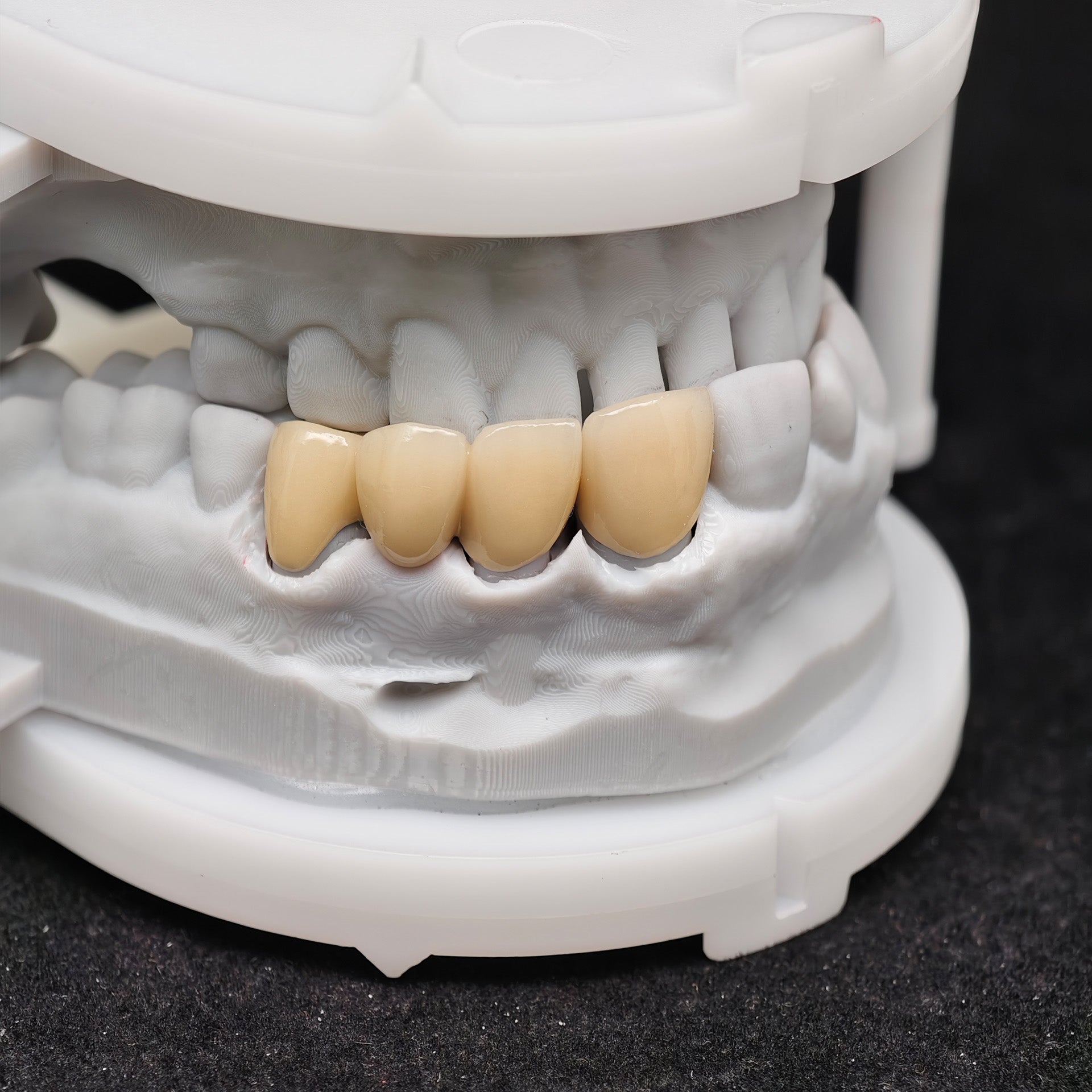 Co - Cr PFM Dental Bridge With Metal Post-And-Core