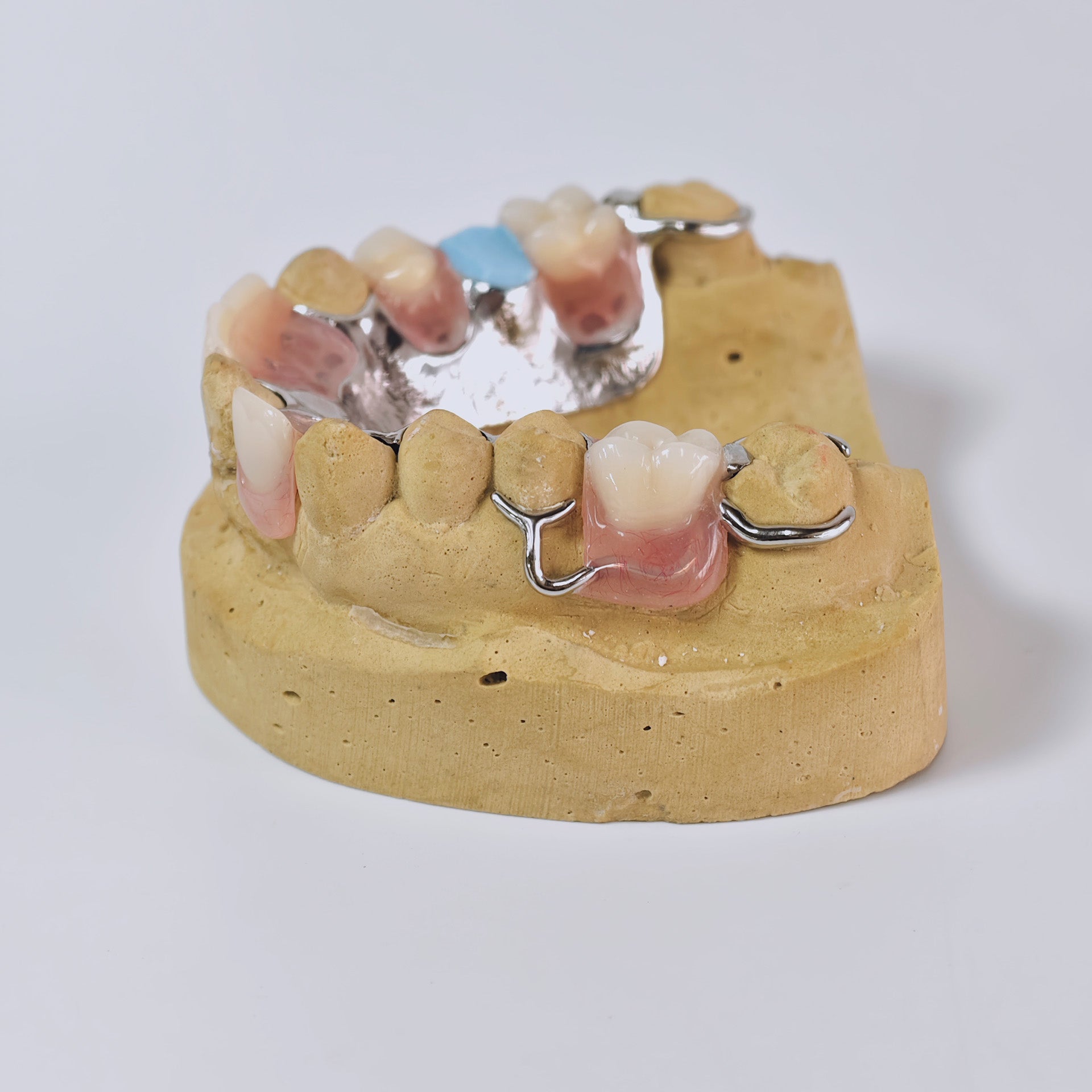 Cobalt Chrome Framework Denture Metal Framework With Acrylic Denture