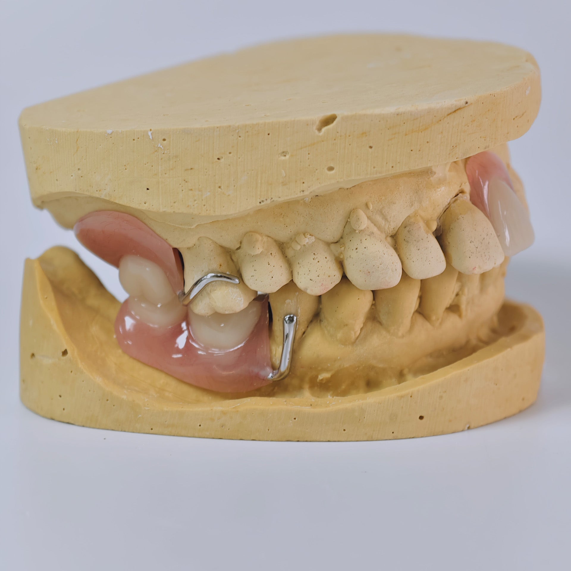Cobalt Chrome Framework Denture Metal Framework With Acrylic Denture