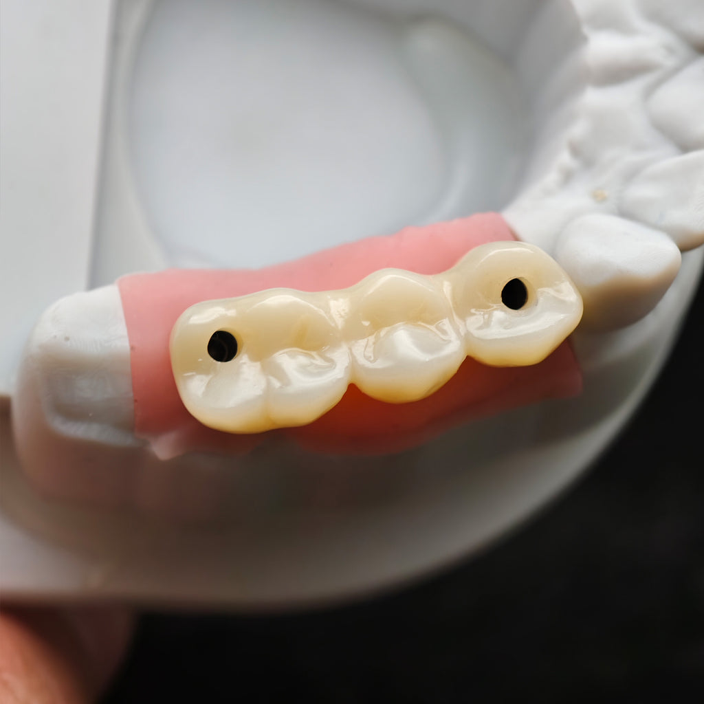 Custom Zirconia Implant Bridge