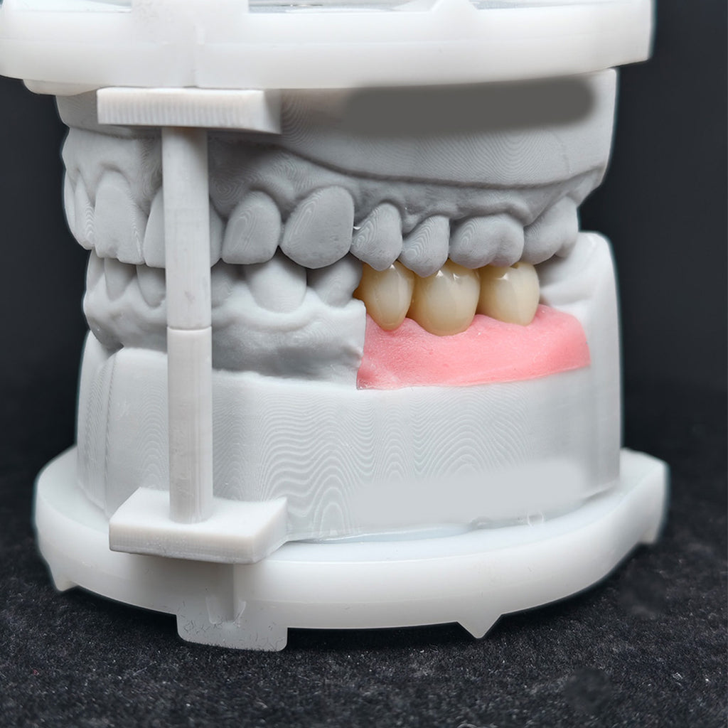 Custom Zirconia Implant Bridge
