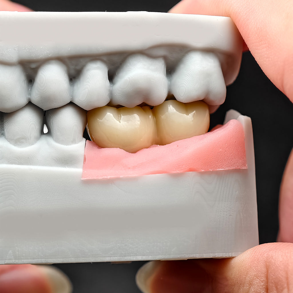 Custom Zirconia Implant Bridge