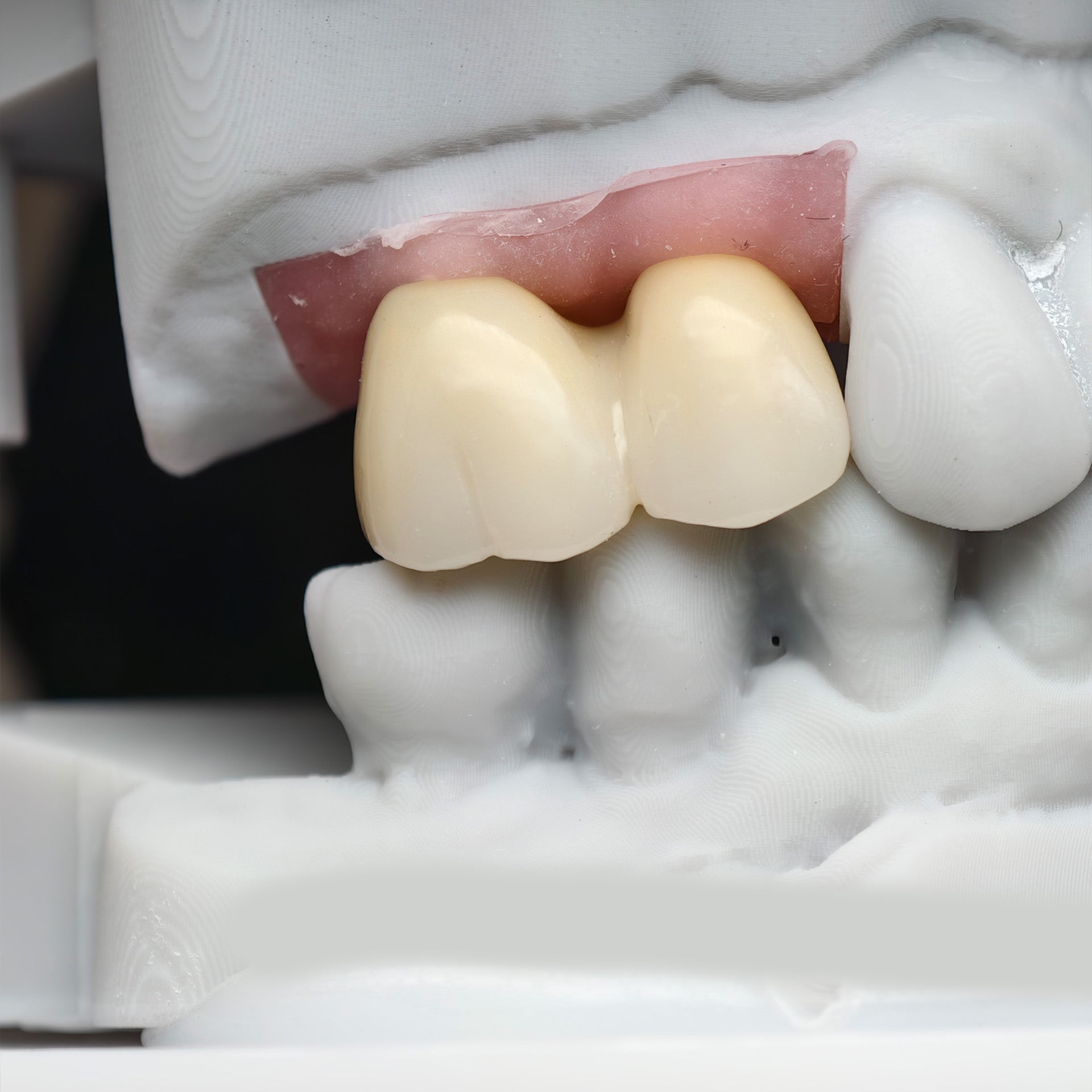 Custom Zirconia Implant Bridge