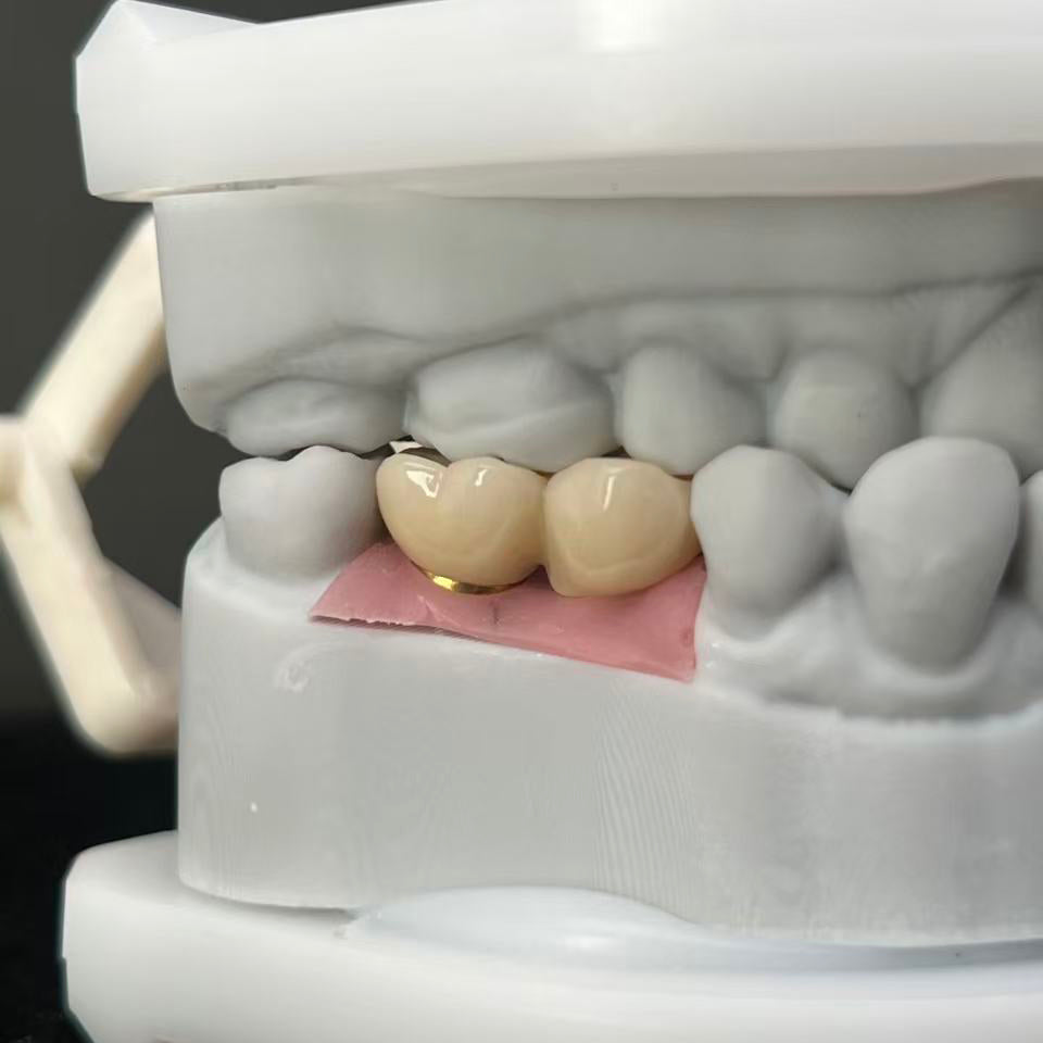 Custom Zirconia Implant Bridge