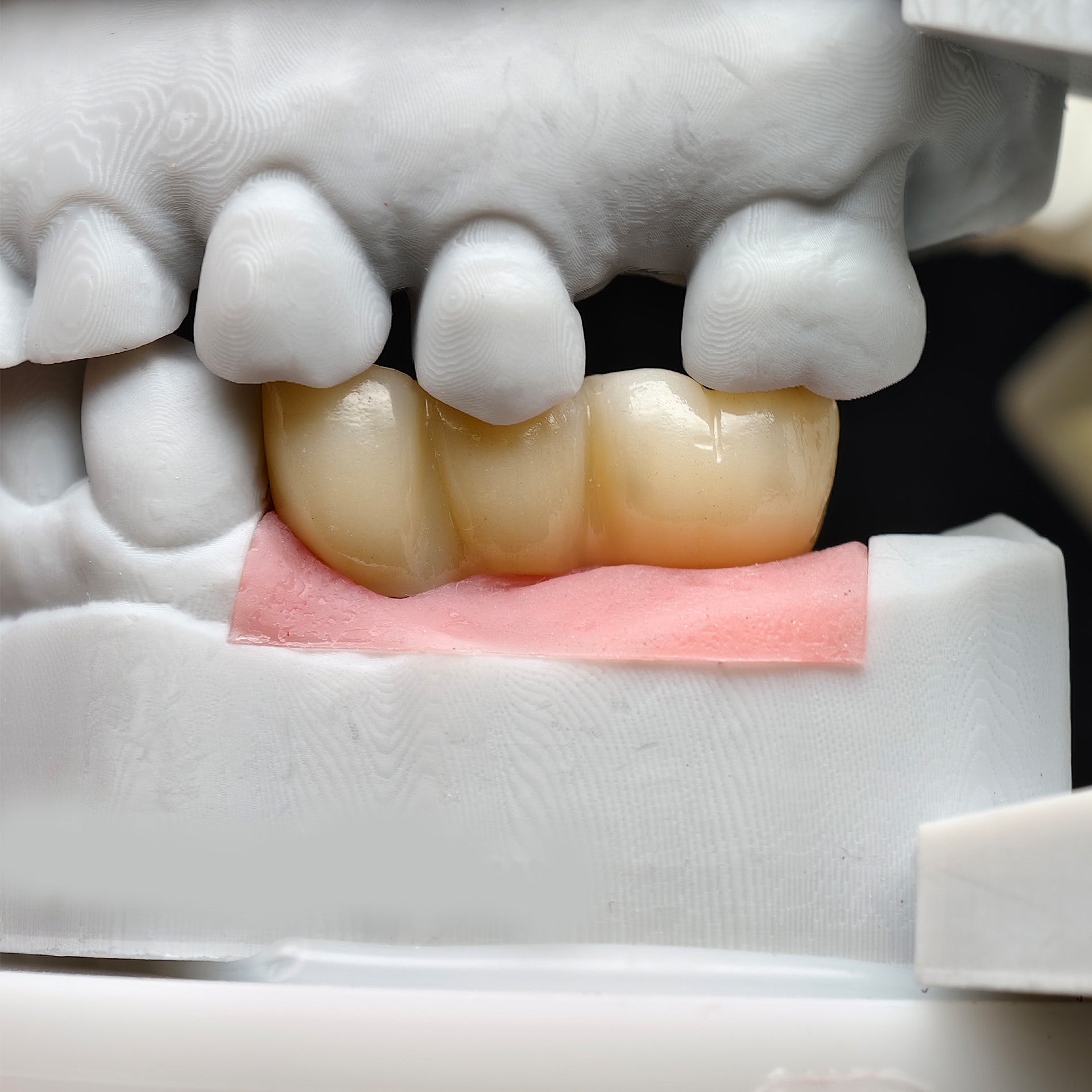 Custom Zirconia Implant Bridge