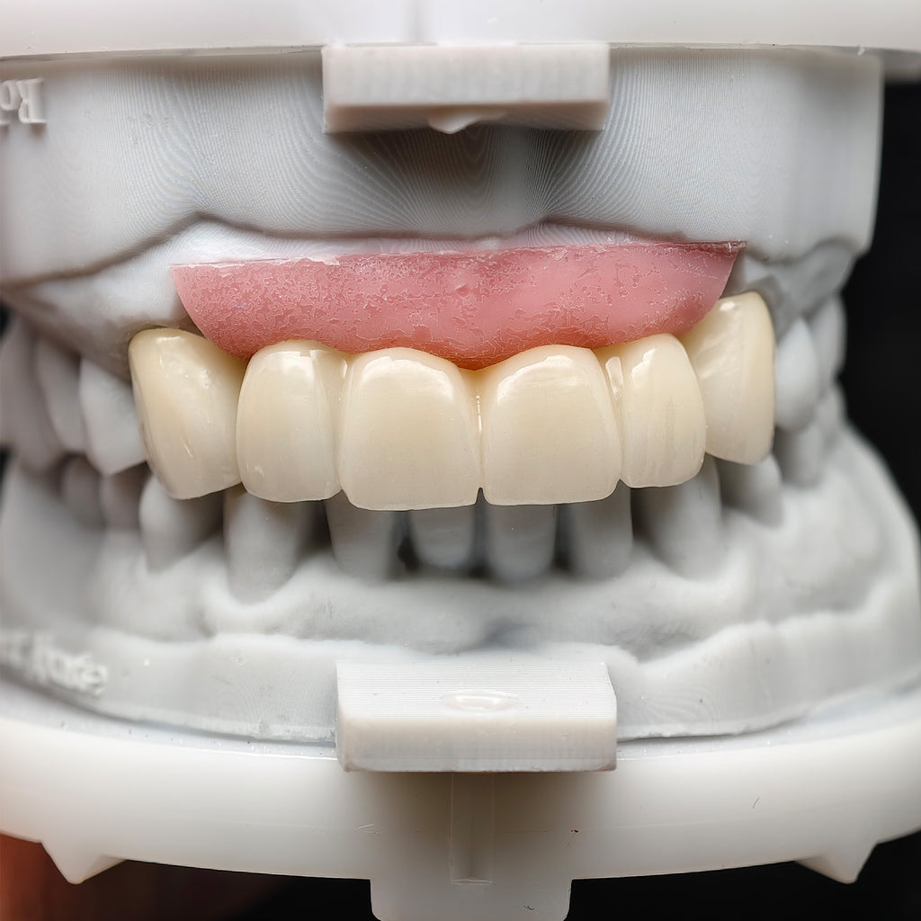 Custom Zirconia Implant Bridge