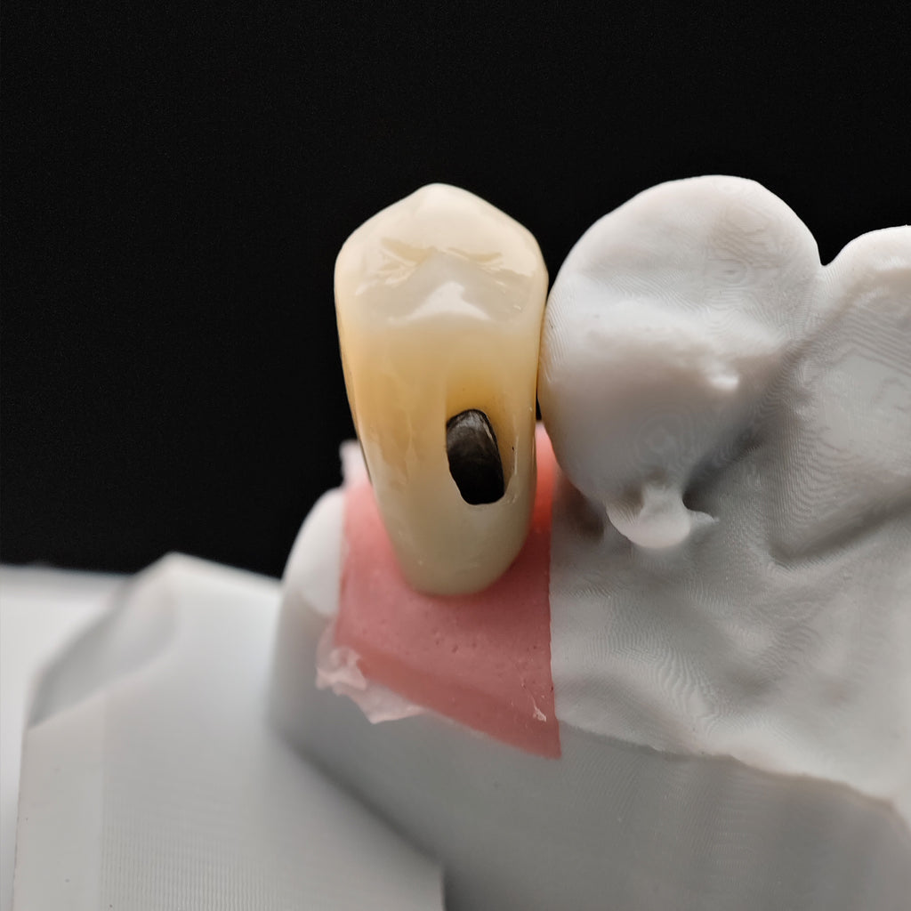 Custom Zirconia Implant Crown