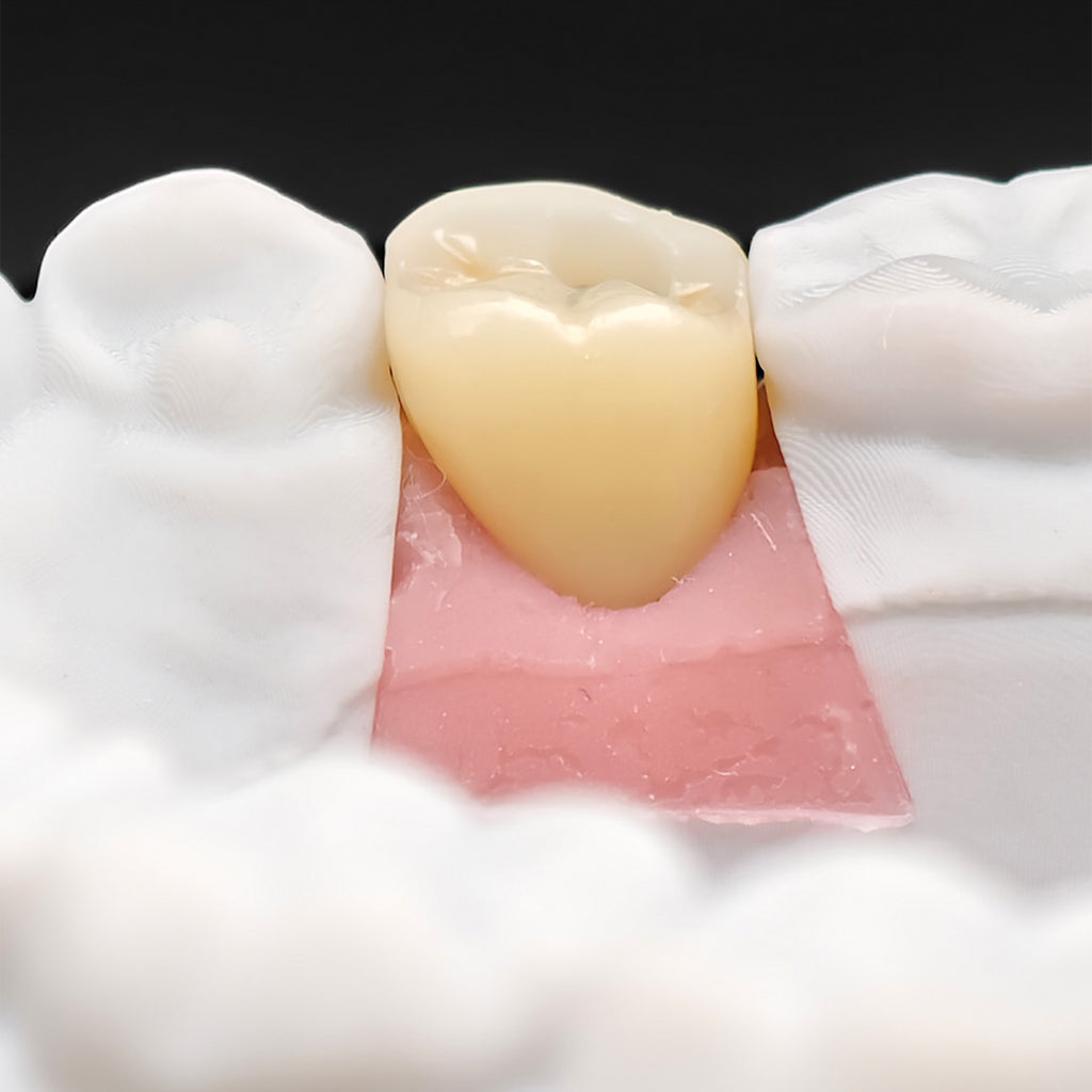 Custom Zirconia Implant Crown