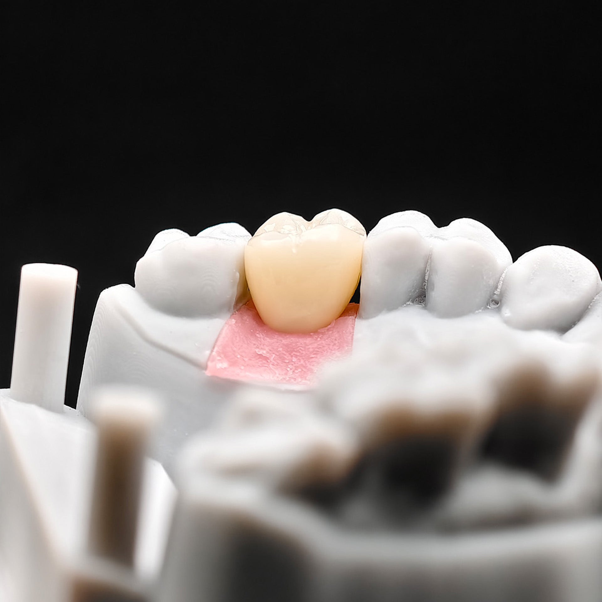 Custom Zirconia Implant Crown