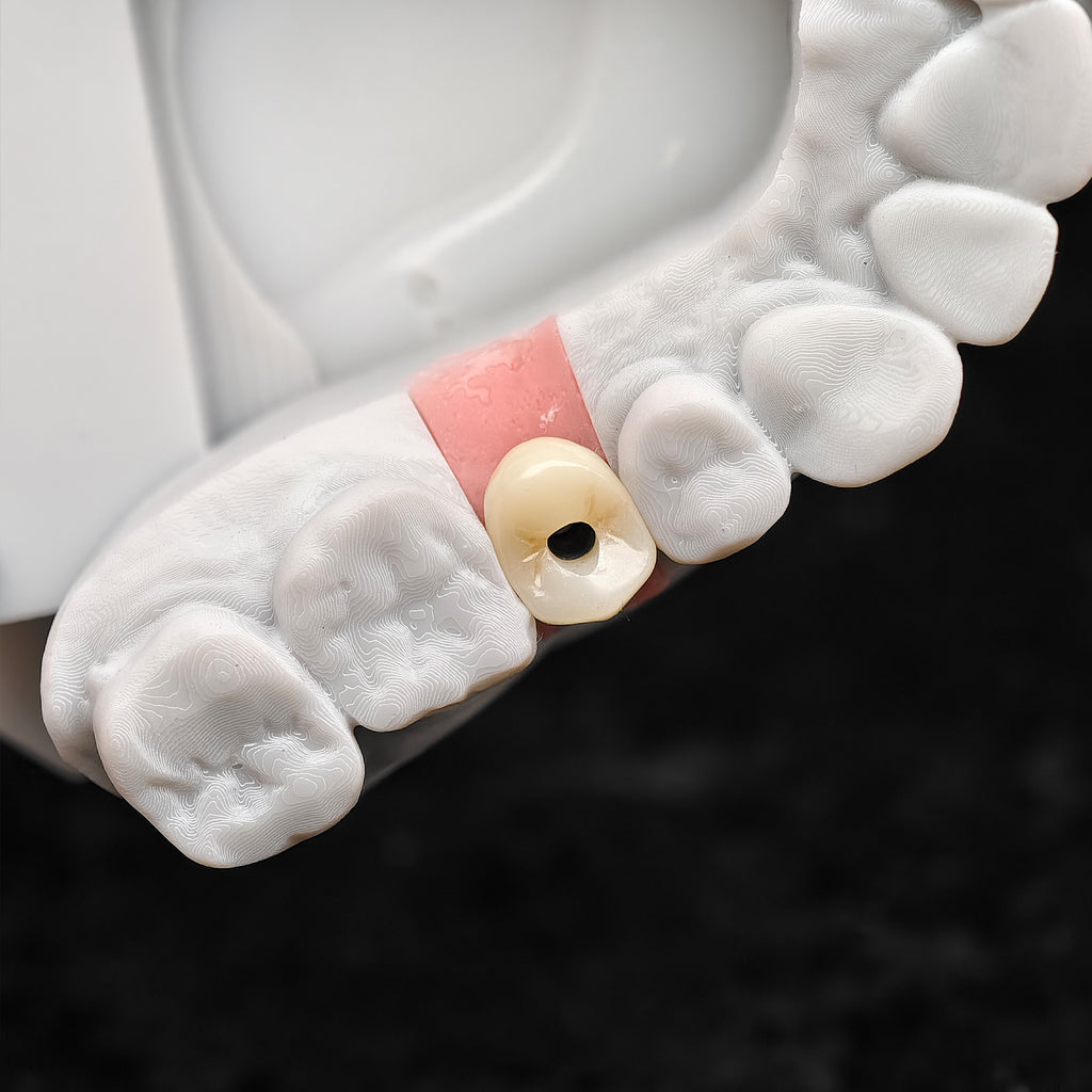 Custom Zirconia Implant Crowns