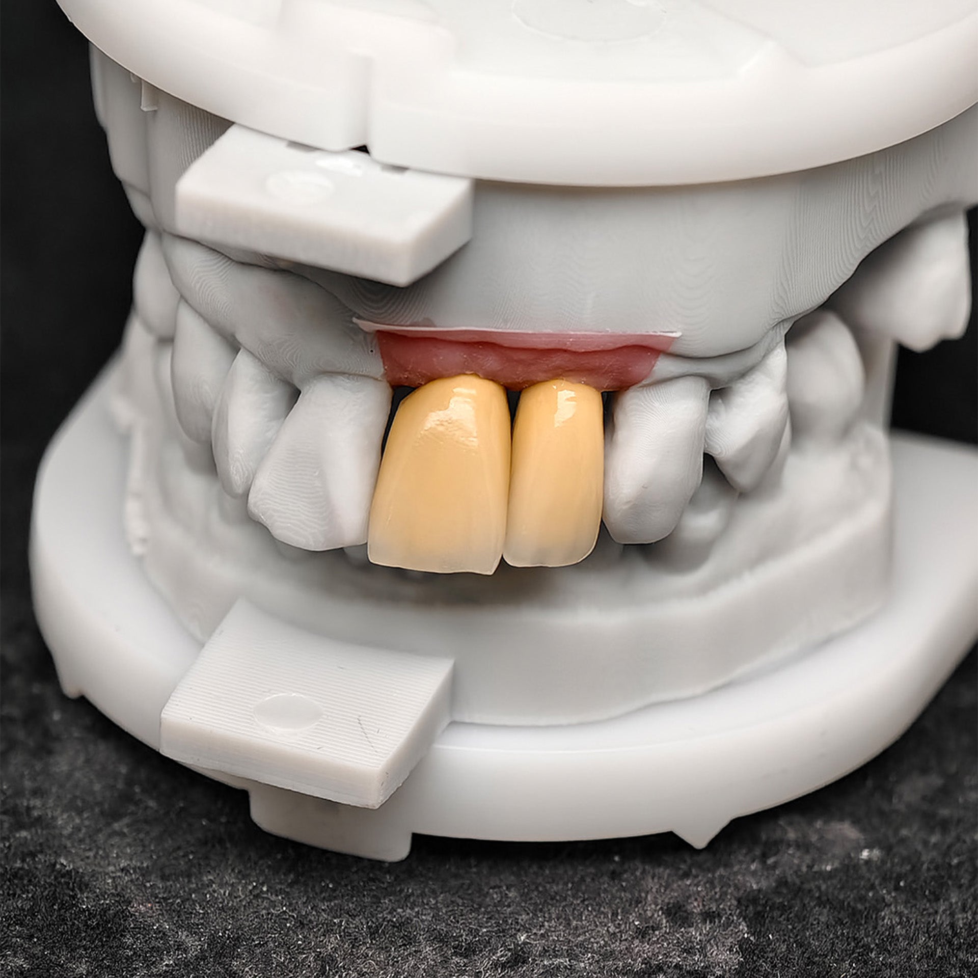 Custom Zirconia Implant Crowns