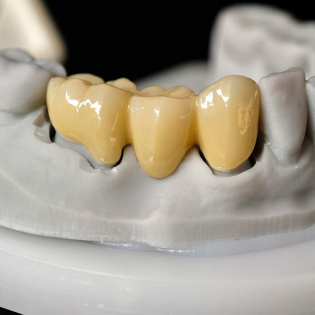 High - Strength Zirconia Bridge