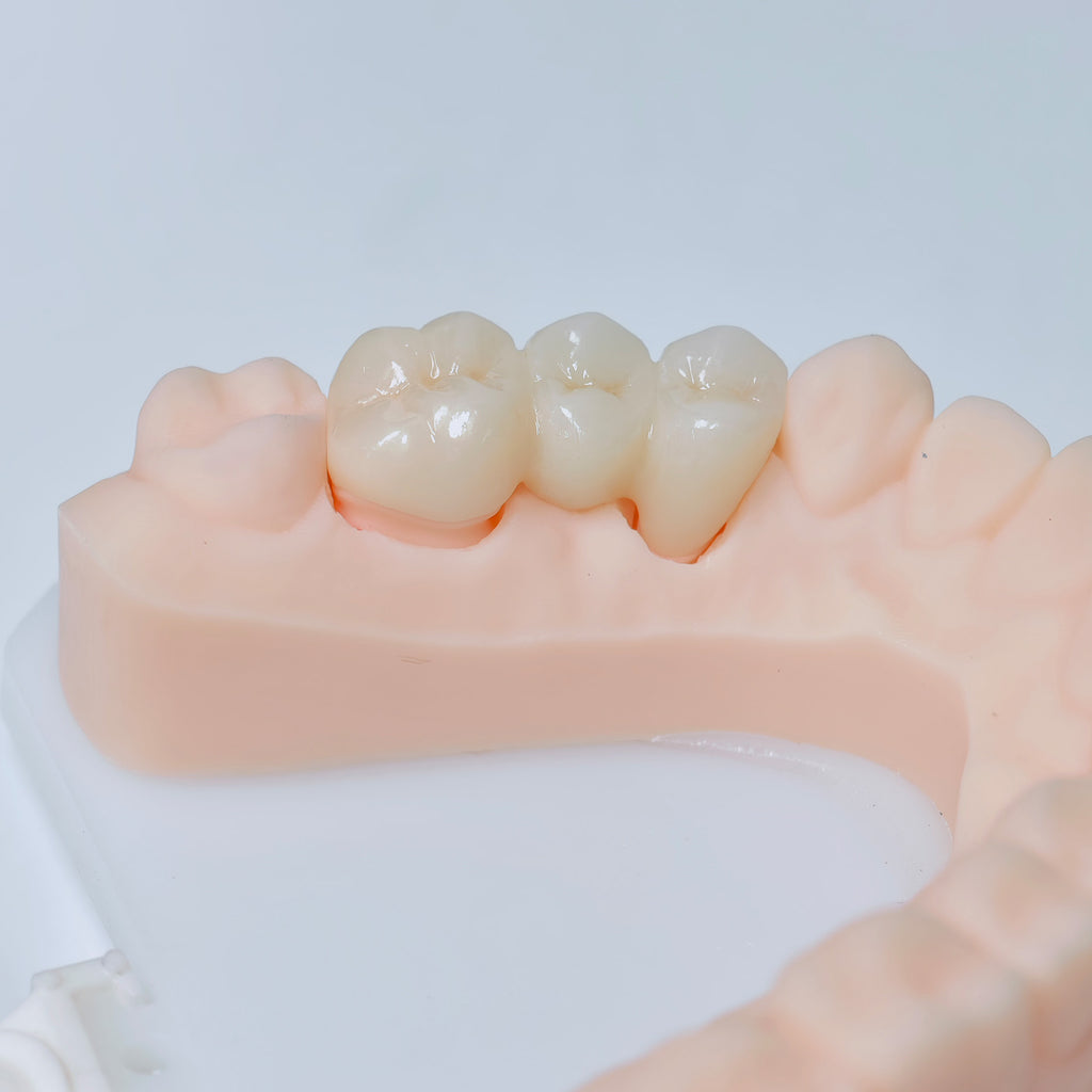 High - Strength Zirconia Bridge