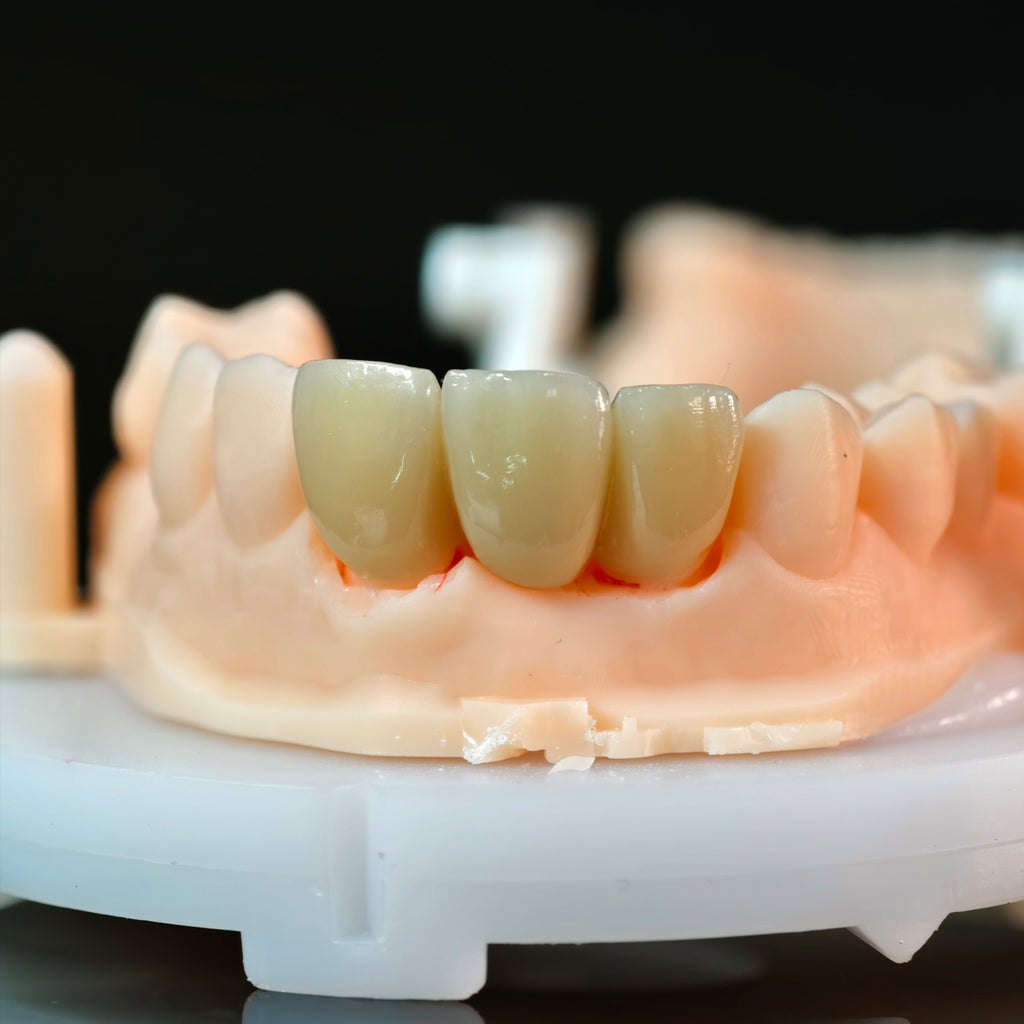 High - Strength Zirconia Bridge