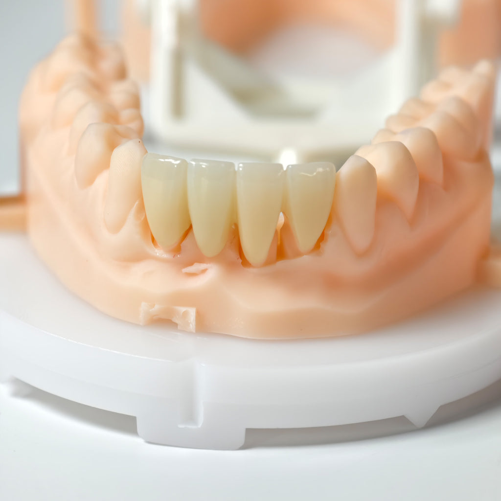 High - Strength Zirconia Bridge