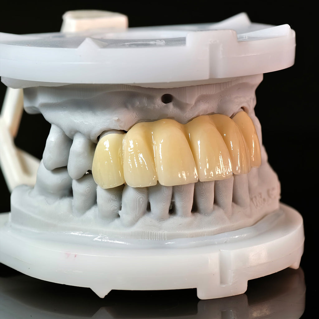 High - Strength Zirconia Bridge
