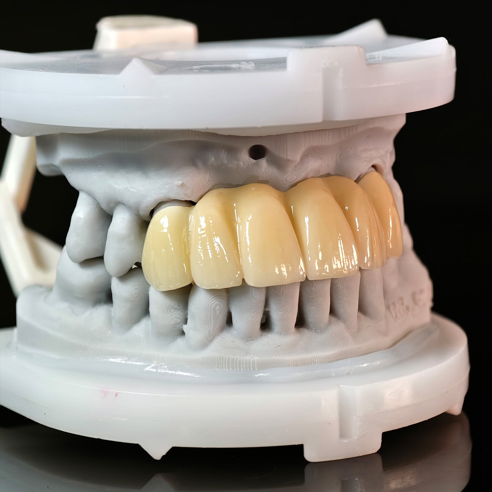 High - Strength Zirconia Bridge