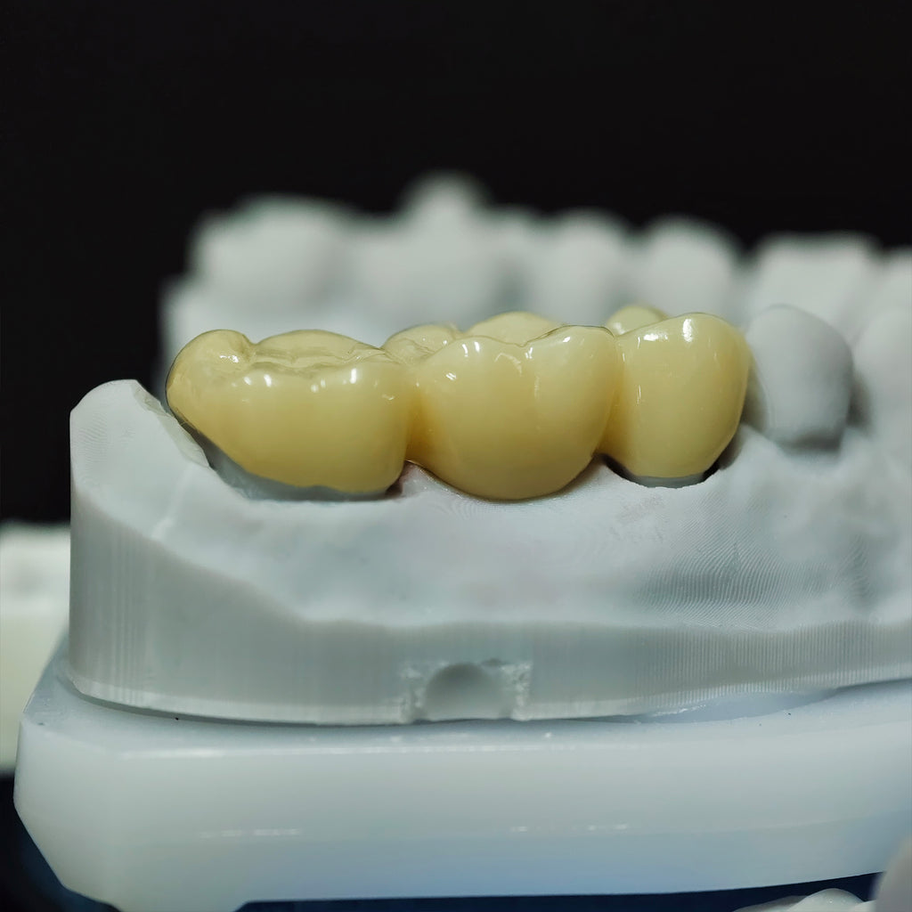 High - Strength Zirconia Bridge