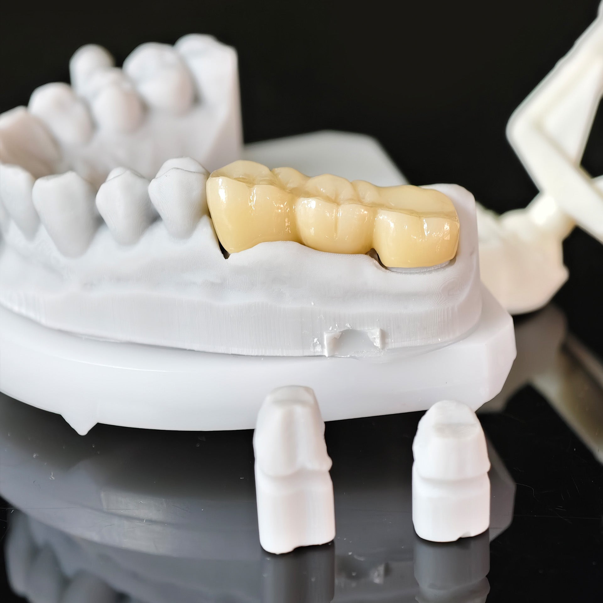 High - Strength Zirconia Bridge