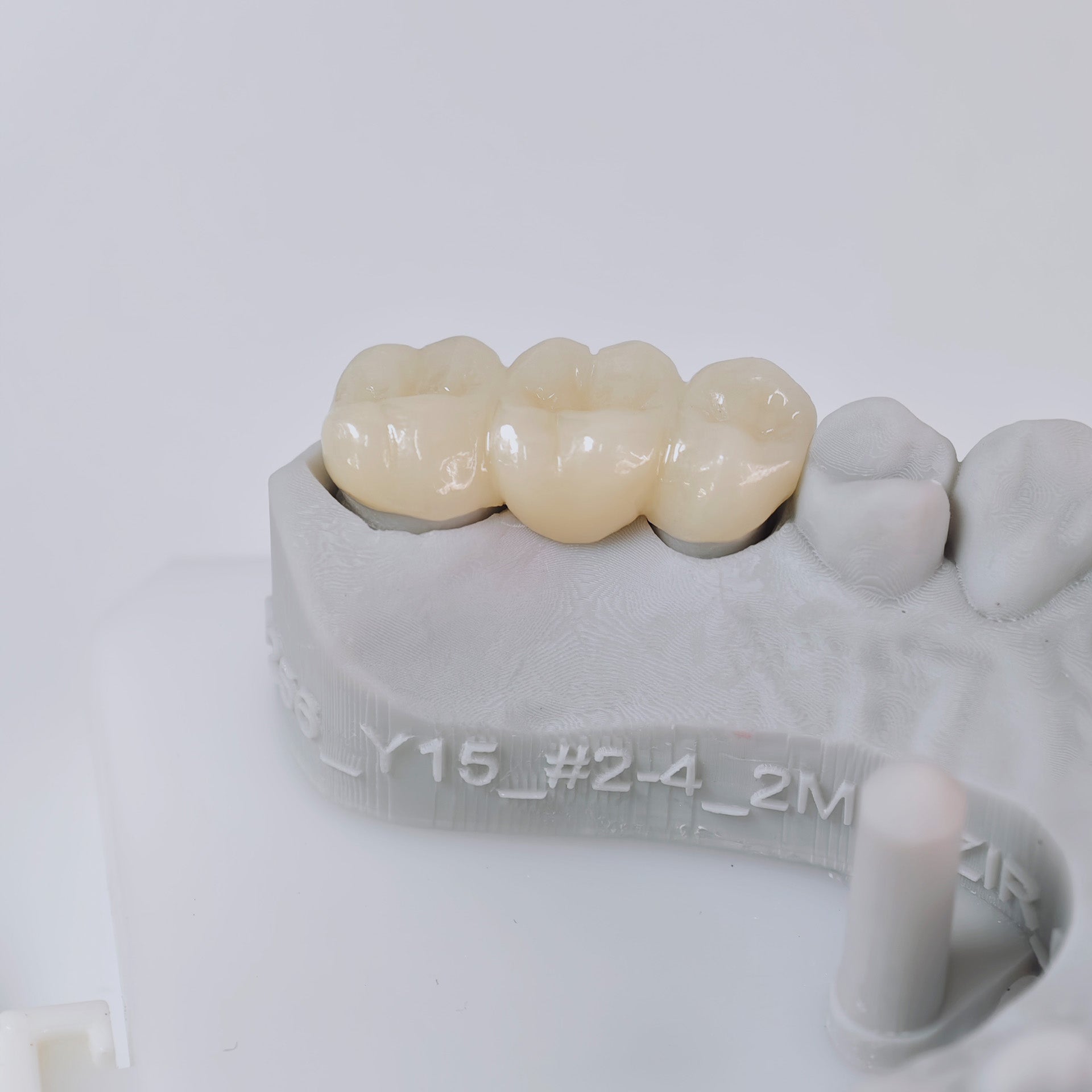 High - Strength Zirconia Bridge