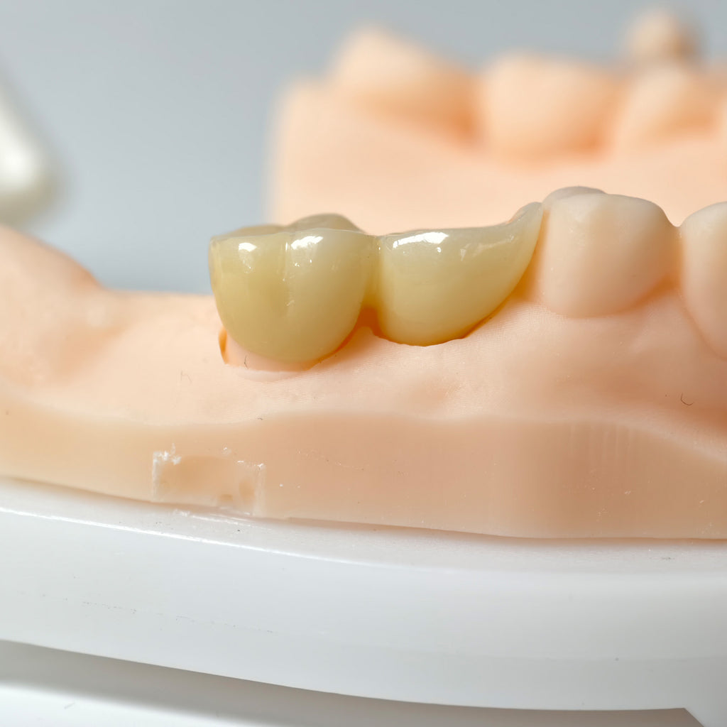 High - Strength Zirconia Bridge