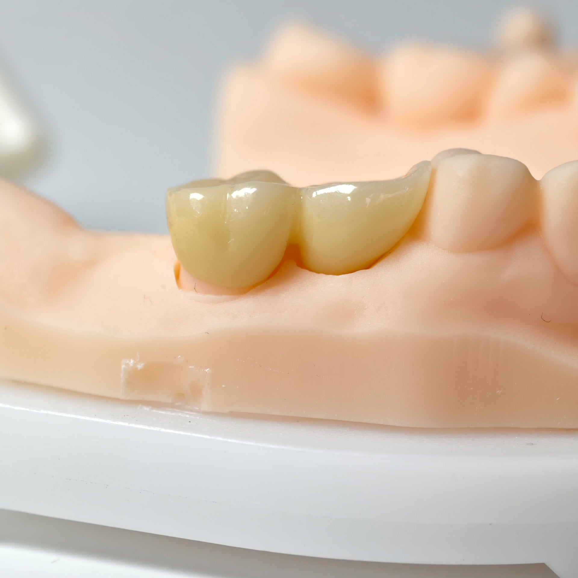 High - Strength Zirconia Bridge