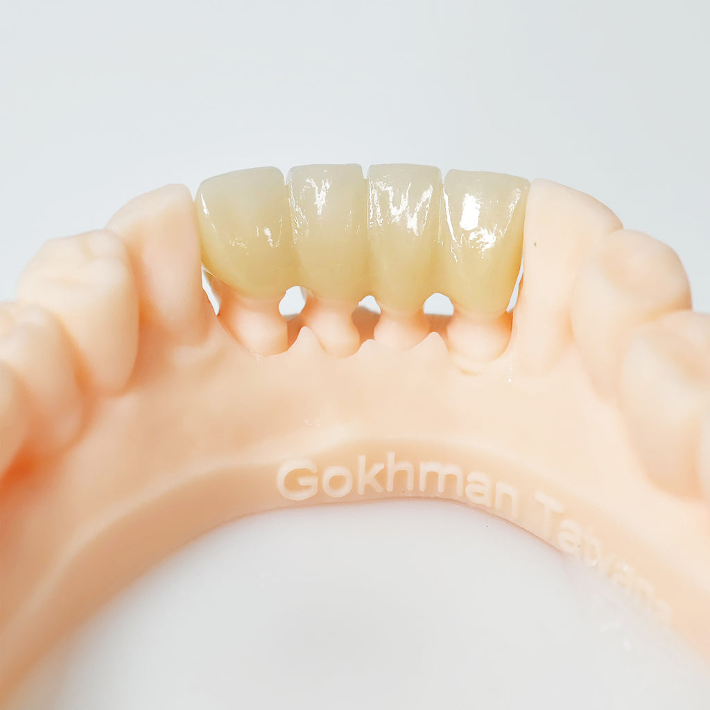 High - Strength Zirconia Bridge