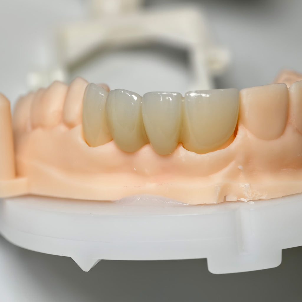 High - Strength Zirconia Bridge