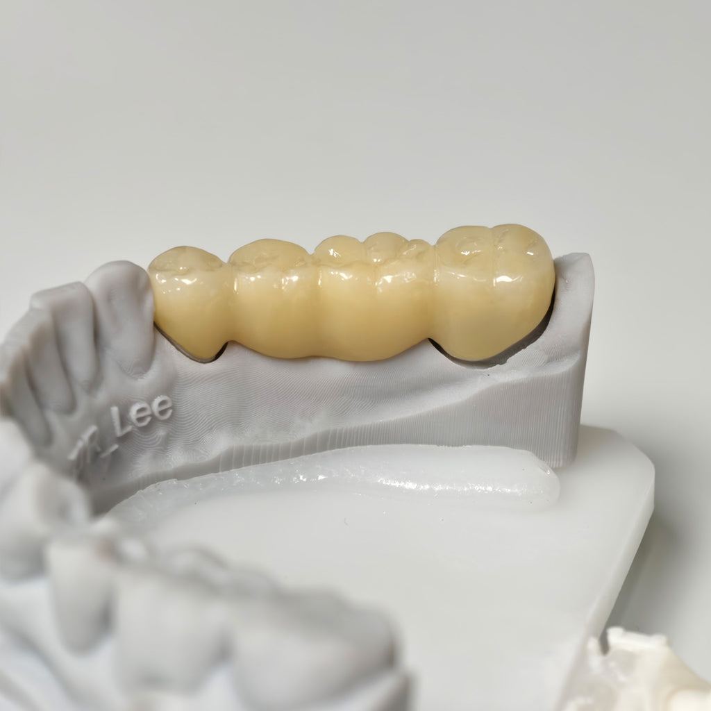 High - Strength Zirconia Bridge