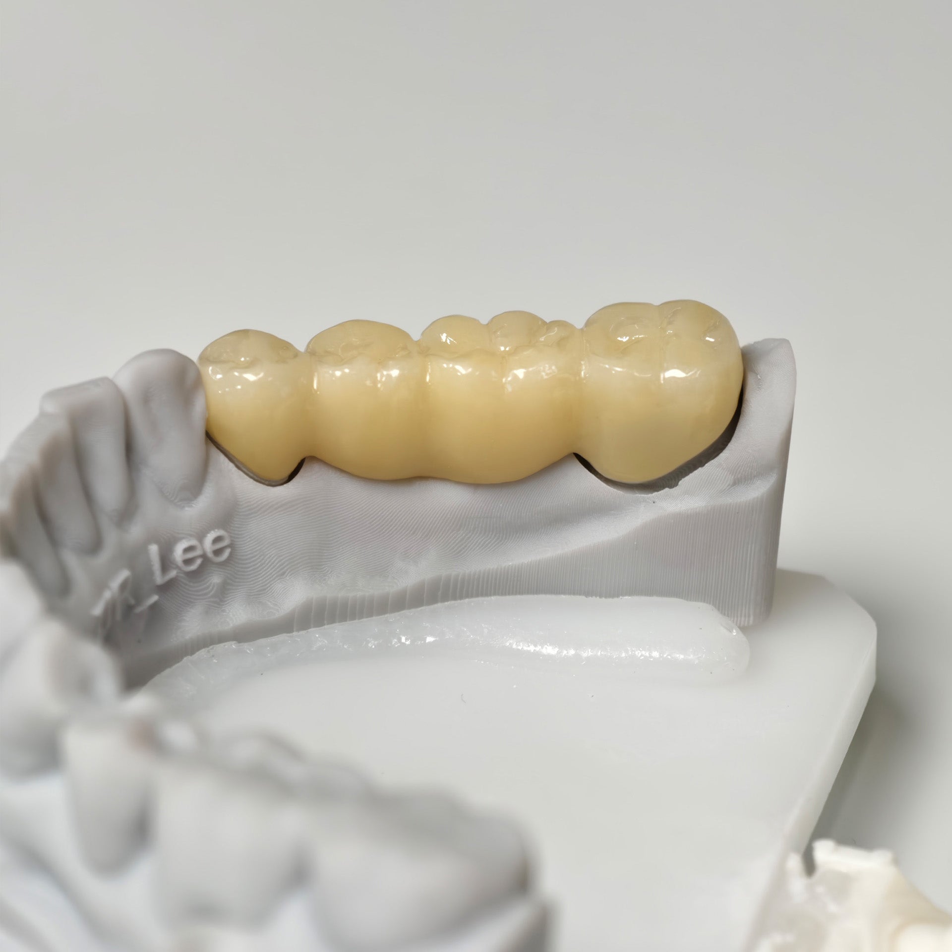 High - Strength Zirconia Bridge