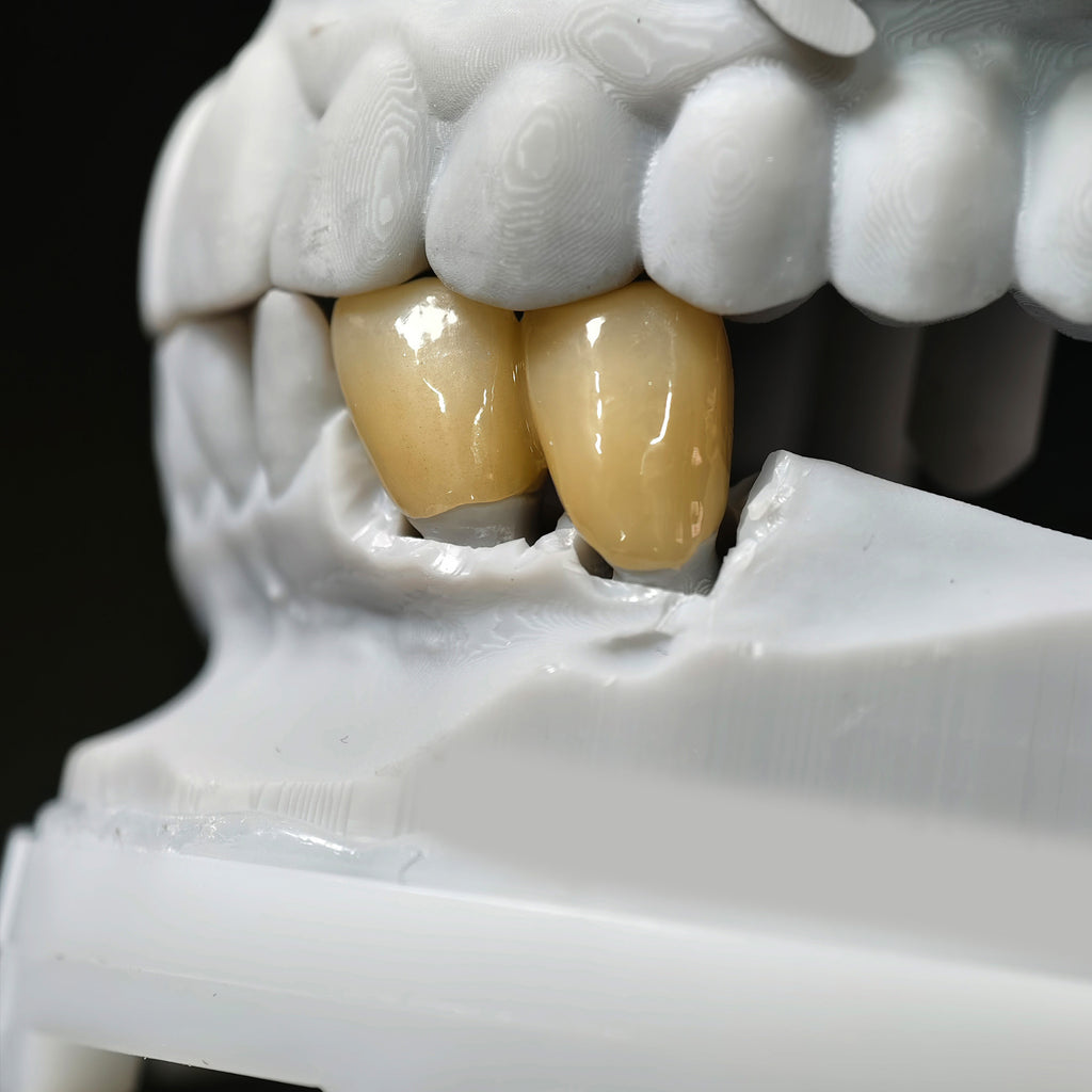 High - Strength Zirconia Bridge