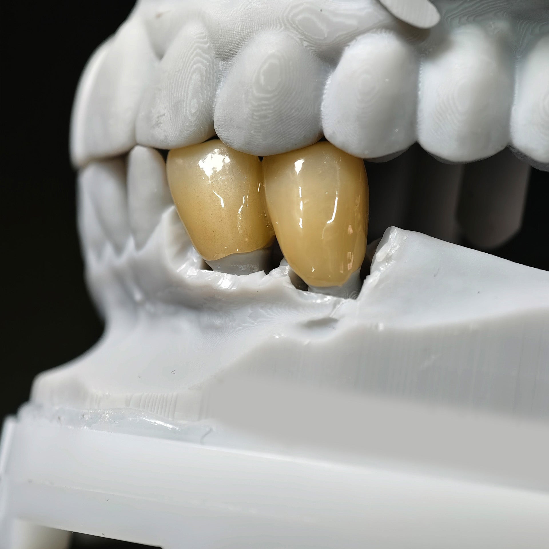 High - Strength Zirconia Bridge