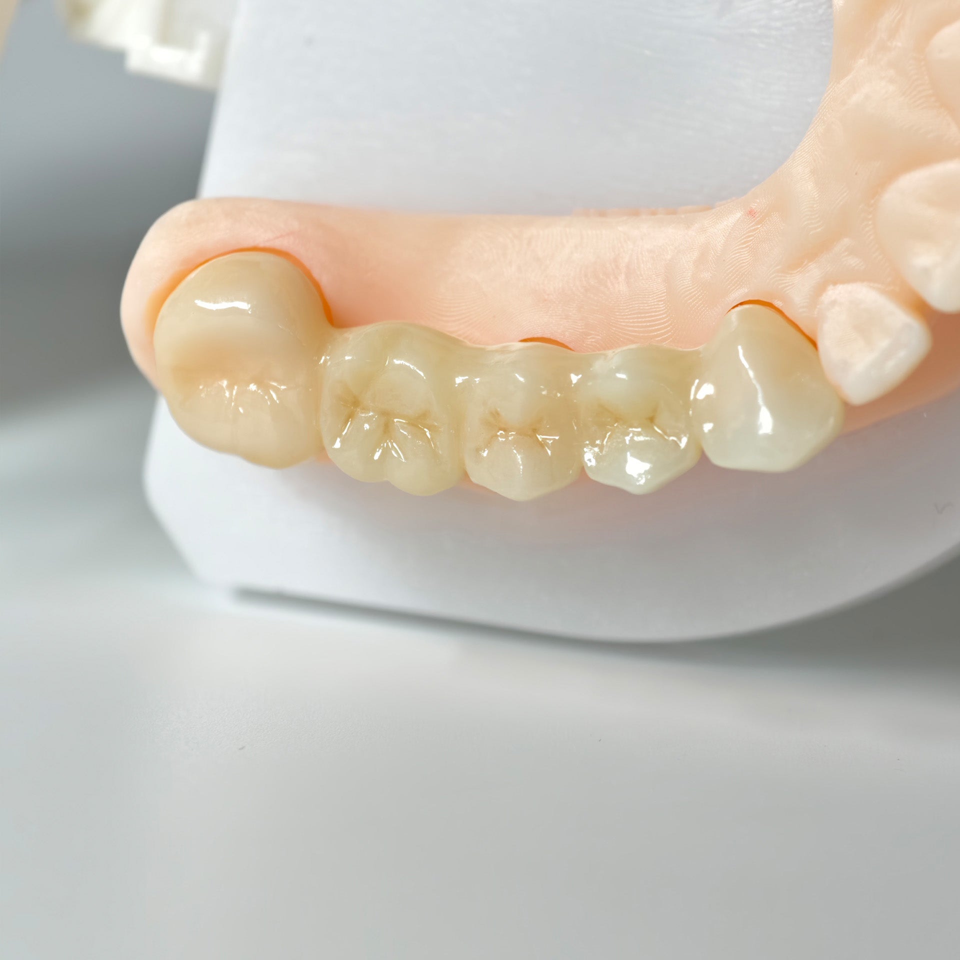 High - Strength Zirconia Bridge