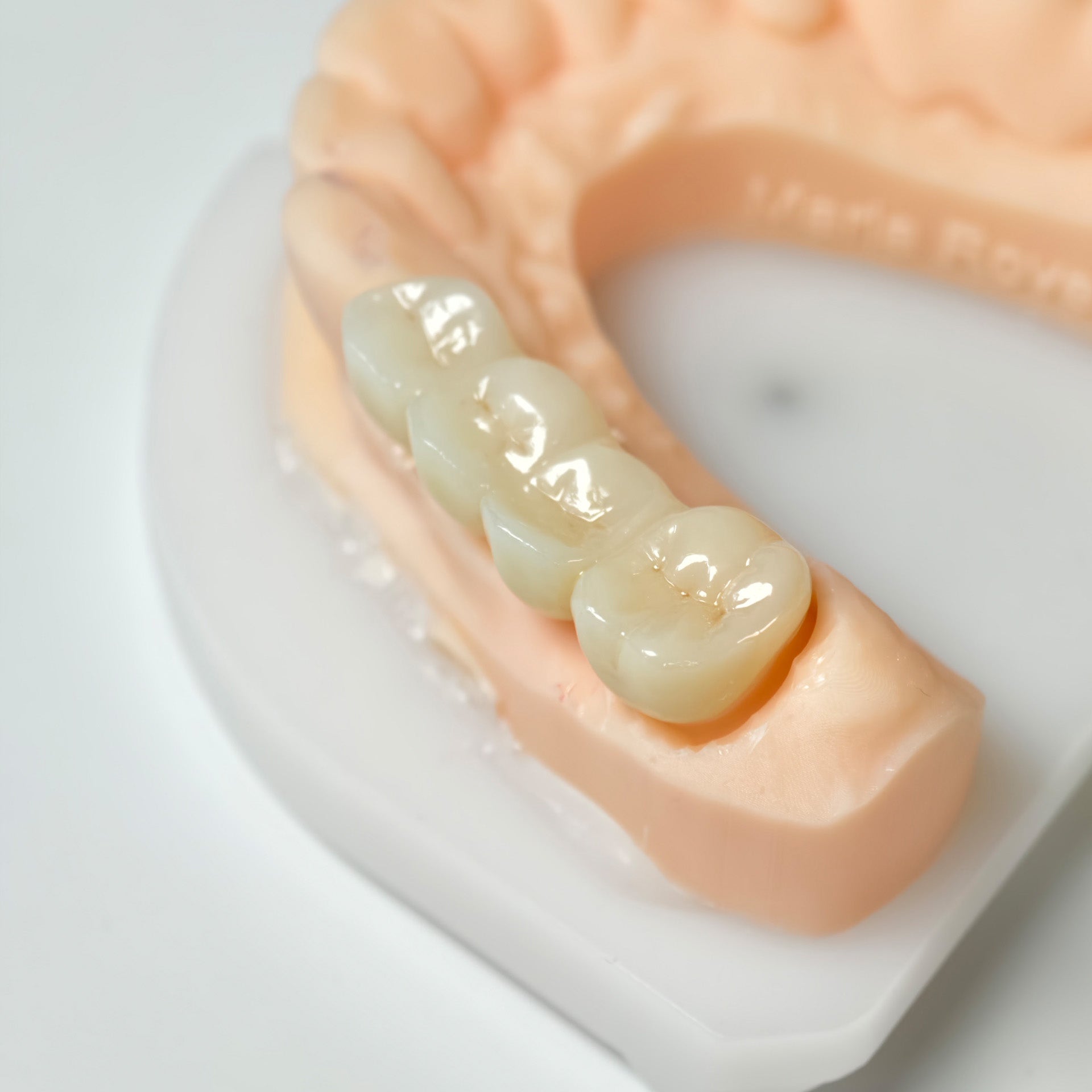 High - Strength Zirconia Bridge
